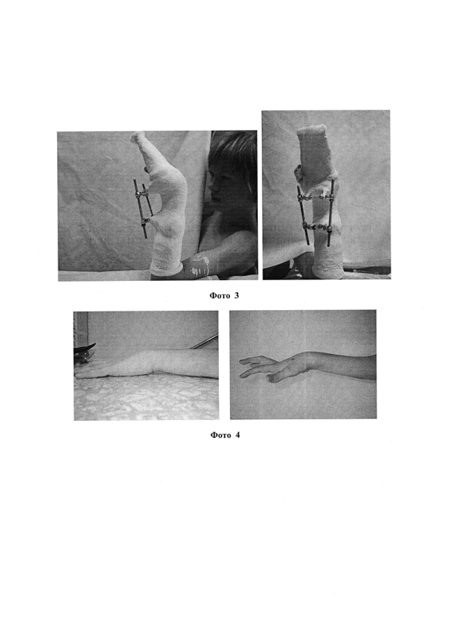 Способ устранения сгибательной контрактуры лучезапястного сустава у больных с детским церебральным параличом (патент 2593743)