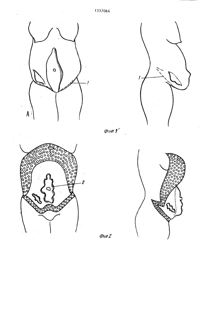 Способ лечения обширных грыж живота (патент 1337064)