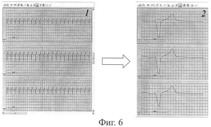Способ неинвазивного электрофизиологического исследования сердца (патент 2409313)