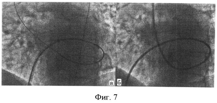 Способ трансвенозного транссептального доступа к артериям головы и шеи (патент 2526464)