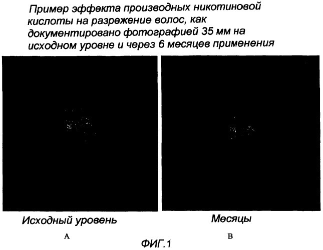 Способ лечения нарушений роста волос, таких как облысение по женскому типу, и применяемые в нем композиции (патент 2381786)