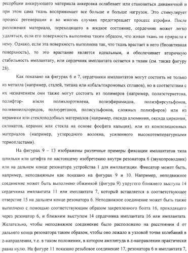Имплантаты для создания соединений с тканями, в частности со скелетом, а также устройство и способ имплантации (патент 2314768)