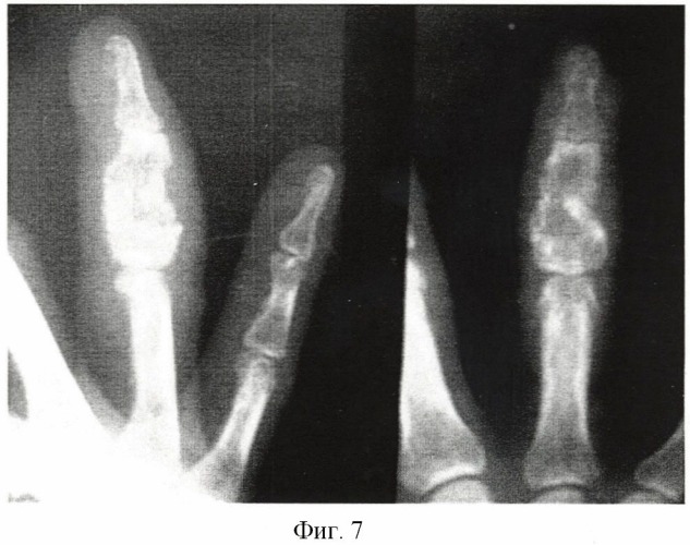 Способ лечения энхондром фаланг и пястных костей кисти (патент 2489107)