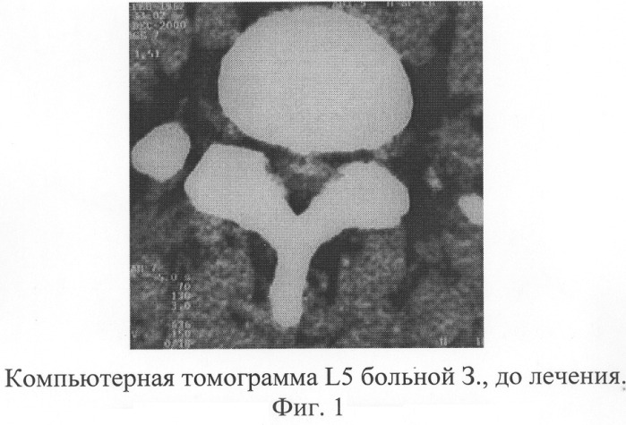 Способ лечения грыжи межпозвонкового диска (патент 2281055)