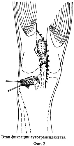 Способ несвободной аутопластики надколенником внутрисуставных дефектов мыщелков большеберцовой кости (патент 2356510)