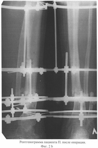 Способ лечения несросшихся переломов и ложных суставов костей голени, осложненных хроническим травматическим остеомиелитом (патент 2311144)