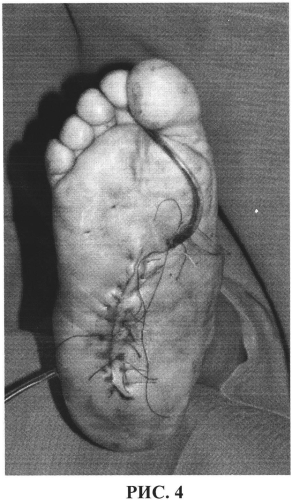Способ хирургического лечения диабетической остеоартропатии среднего отдела стопы в стадии трофических нарушений (патент 2570970)
