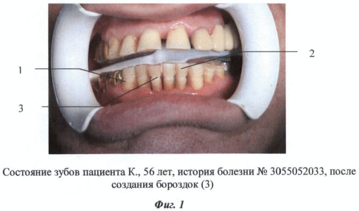 Способ шинирования зубов при пародонтите (патент 2436540)