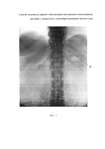 Способ эндоваскулярной эмболизации внутренних подвздошных артерий у пациенток с новообразованиями малого таза (патент 2576092)