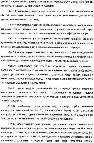 Устройство для лечения путем подкожной подачи пониженного давления с использованием текучей магистрали и связанный с ним способ (патент 2405459)