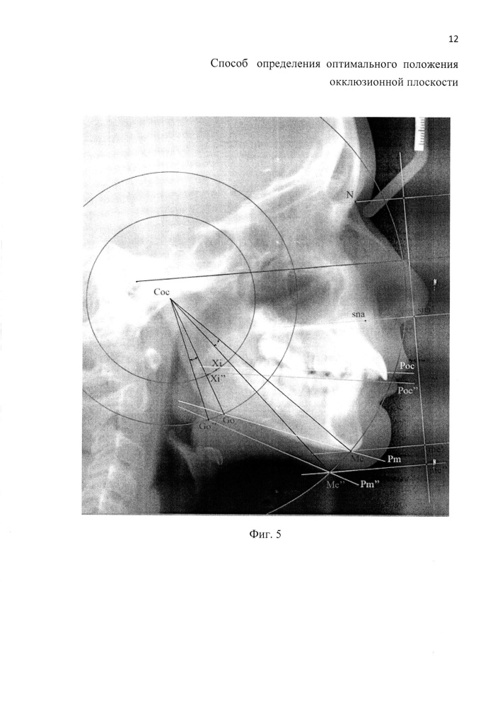 Способ определения оптимального положения окклюзионной плоскости (патент 2610531)