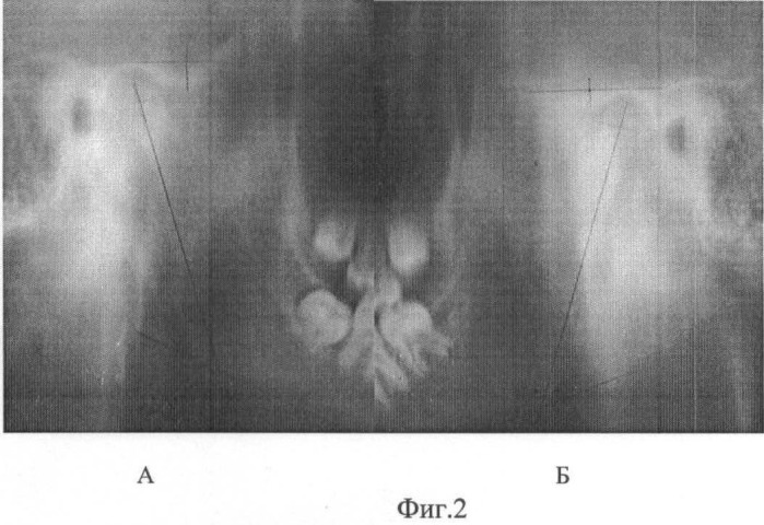 Способ рентгенодиагностики различных типов дисплазии височно-нижнечелюстного сустава (патент 2462993)