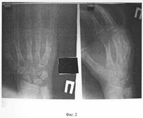 Способ фиксации коротких трубчатых костей кисти для лечения их переломов и деформаций (патент 2280415)