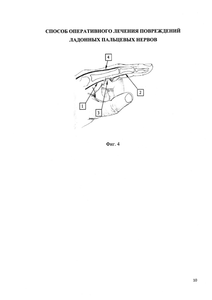 Способ оперативного лечения повреждений ладонных пальцевых нервов (патент 2612122)