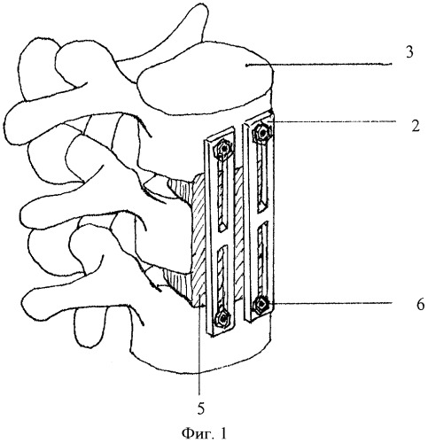 Способ фиксации нестабильных повреждений позвоночника (патент 2428947)