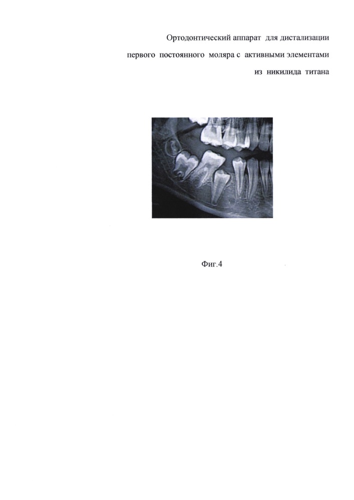 Способ изготовления ортодонтического аппарата и ортодонтический аппарат для дистализации первого постоянного моляра с активными элементами из никелид титана (патент 2635961)