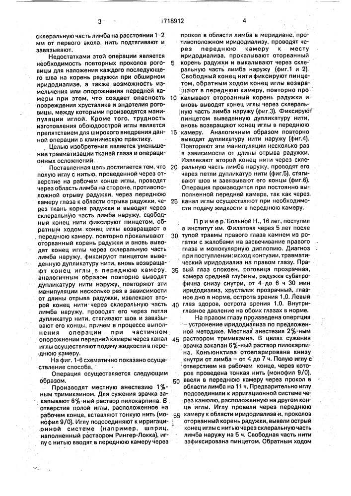 Способ устранения иридодиализа (патент 1718912)
