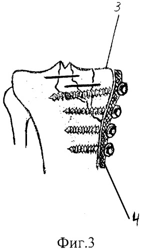 Способ лечения оскольчатых компрессионных внутрисуставных переломов метаэпифизов трубчатых костей (патент 2302213)