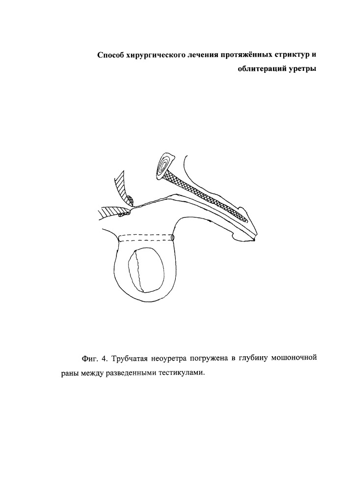 Способ хирургического лечения протяжённых стриктур и облитераций уретры (патент 2657939)
