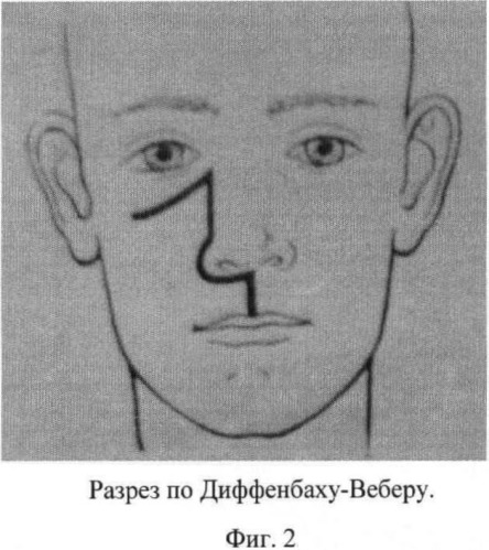 Способ хирургического доступа при резекции верхней челюсти (патент 2477980)