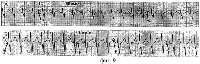 Способ диагностики атриовентрикулярной узловой эктопической тахикардии у детей после хирургического лечения врожденных пороков сердца выявлением атриовентрикулярной диссоциации на экг с применением медикаментозных препаратов (варианты) (патент 2453264)