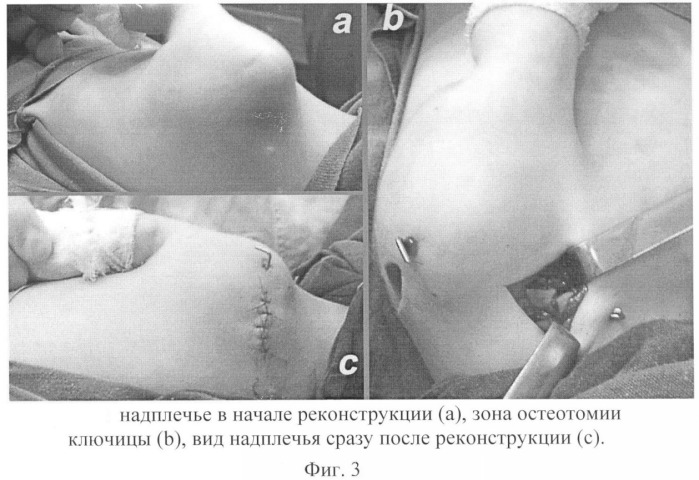 Способ реконструкции надплечья при его деформации (патент 2332182)