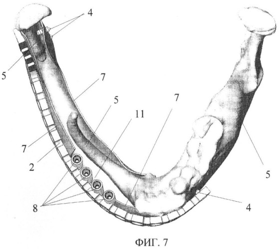 Устройство для устранения дефектов и деформаций кости нижней челюсти (патент 2387410)