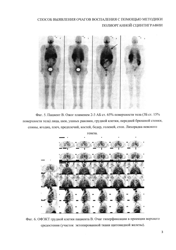 Способ выявления очагов воспаления с помощью методики полиорганной сцинтиграфии (патент 2648877)