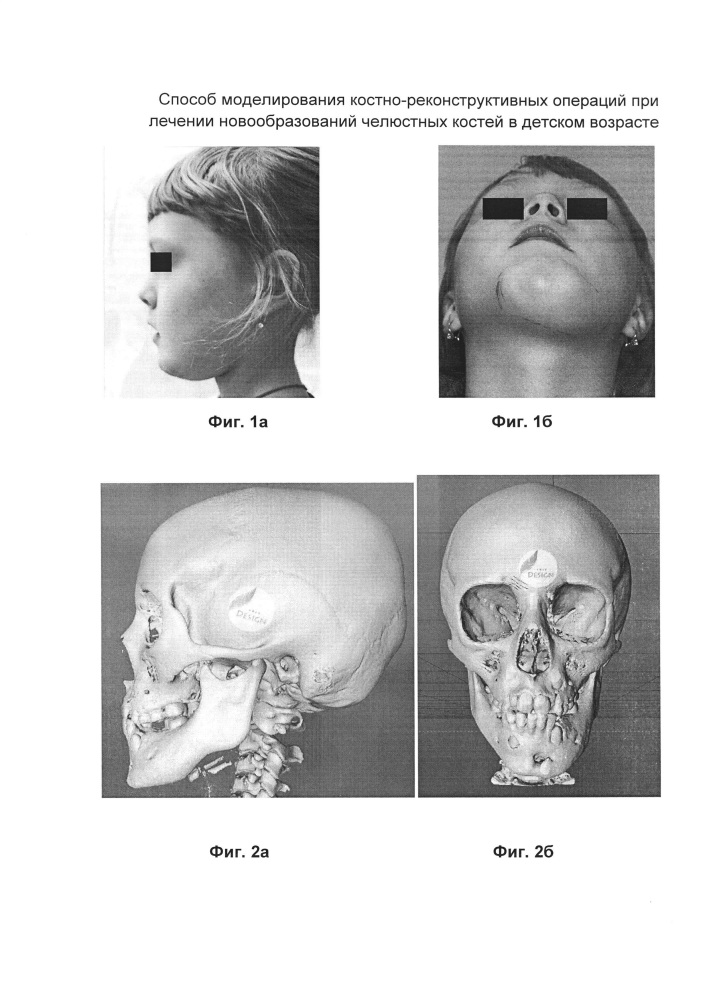 Способ моделирования костно-реконструктивных операций при лечении новообразований челюстных костей в детском возрасте (патент 2607651)