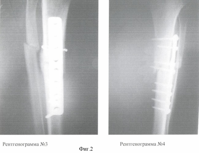 Способ лечения многооскольчатых и множественных переломов длинных трубчатых костей (патент 2370227)