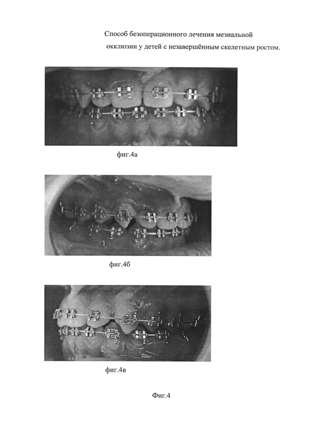 Способ безоперационного лечения мезиальной окклюзии у детей с незавершённым скелетным ростом (патент 2593234)