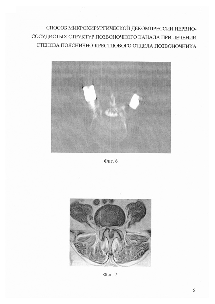 Способ микрохирургической декомпрессии нервно-сосудистых структур позвоночного канала при лечении стеноза пояснично-крестцового отдела позвоночника (патент 2628653)