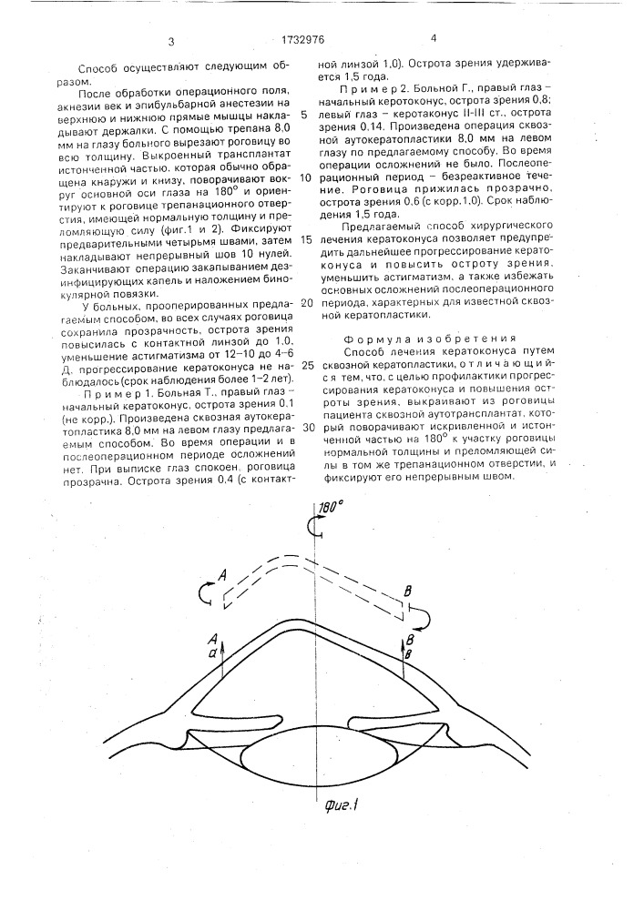 Способ лечения кератоконуса (патент 1732976)