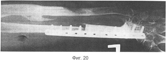 Способ лечения дефектов костей предплечья (патент 2350294)