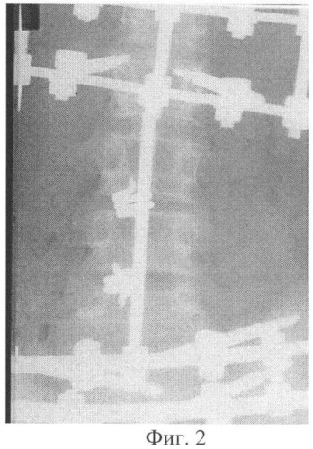 Способ соединения тел позвонков (патент 2340302)