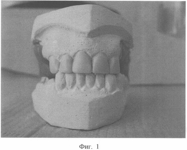 Способ изготовления временных протезов (патент 2355354)