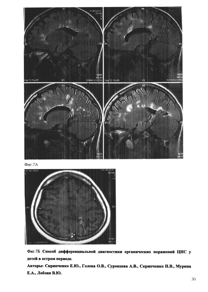 Способ дифференциальной диагностики органических поражений цнс у детей в остром периоде (патент 2648215)
