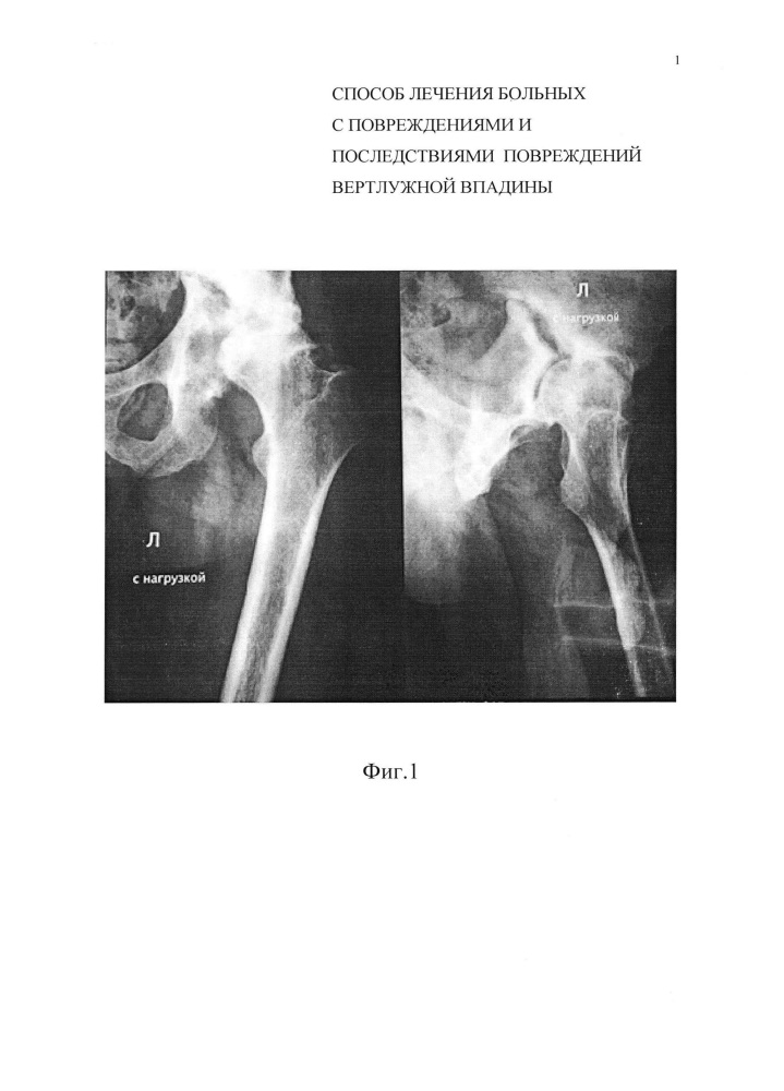 Способ лечения больных с повреждениями и последствиями повреждений вертлужной впадины (патент 2644713)