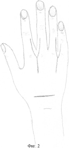 Способ восстановления активного разгибания межфаланговых суставов трехфаланговых пальцев кисти при нейрогенных деформациях (патент 2397722)