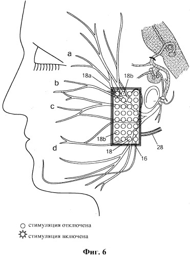 Система и способ стимуляции лицевого нерва (патент 2511082)