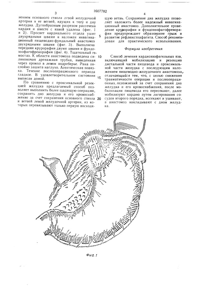 Способ лечения кардиоэзофагельных язв (патент 1607782)