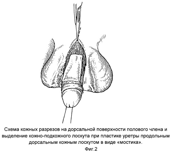 Способ формирования кожного лоскута при пластике уретры по поводу &quot;проксимальной&quot; гипоспадии по кравцову ю.а. - ii (патент 2467707)