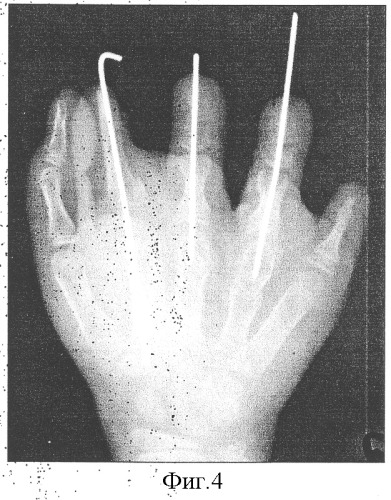 Способ восстановления пальцев при врожденных пороках кисти (патент 2316277)