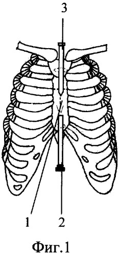 Способ лечения врожденной воронкообразной деформации грудной клетки у детей (патент 2283052)