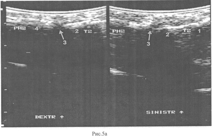 Способ ультразвуковой диагностики стадий болезни фрейберга (патент 2537891)