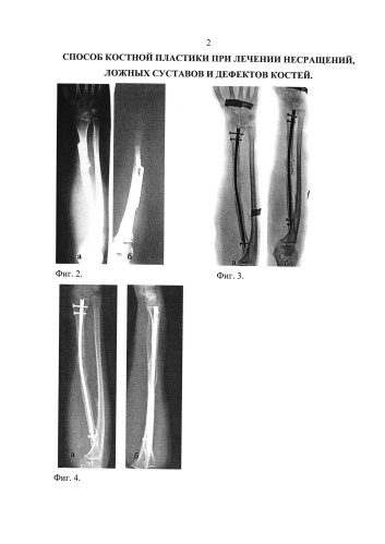 Способ костной пластики при лечении несращений, ложных суставов и дефектов костей (патент 2577937)
