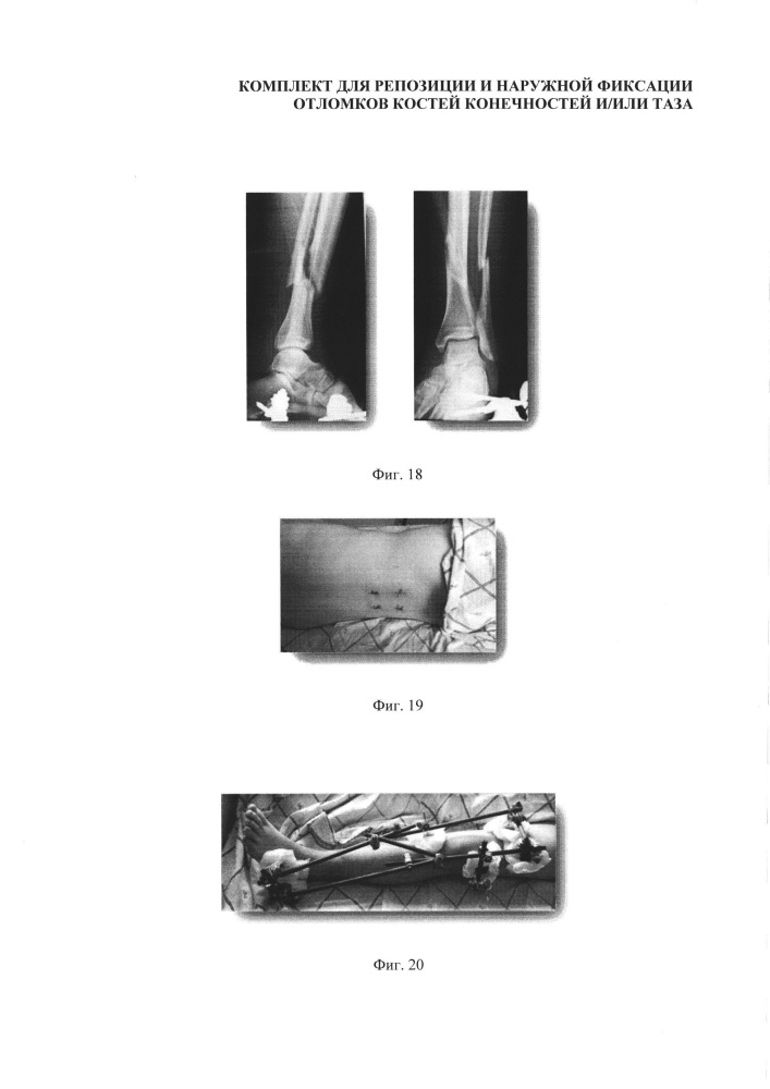 Комплект для репозиции и наружной фиксации отломков костей конечностей и/или таза (патент 2606269)