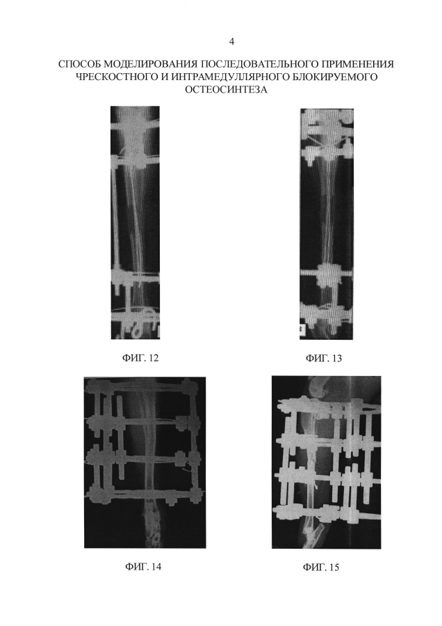 Способ моделирования последовательного применения чрескостного и интрамедуллярного блокируемого остеосинтеза (патент 2593583)