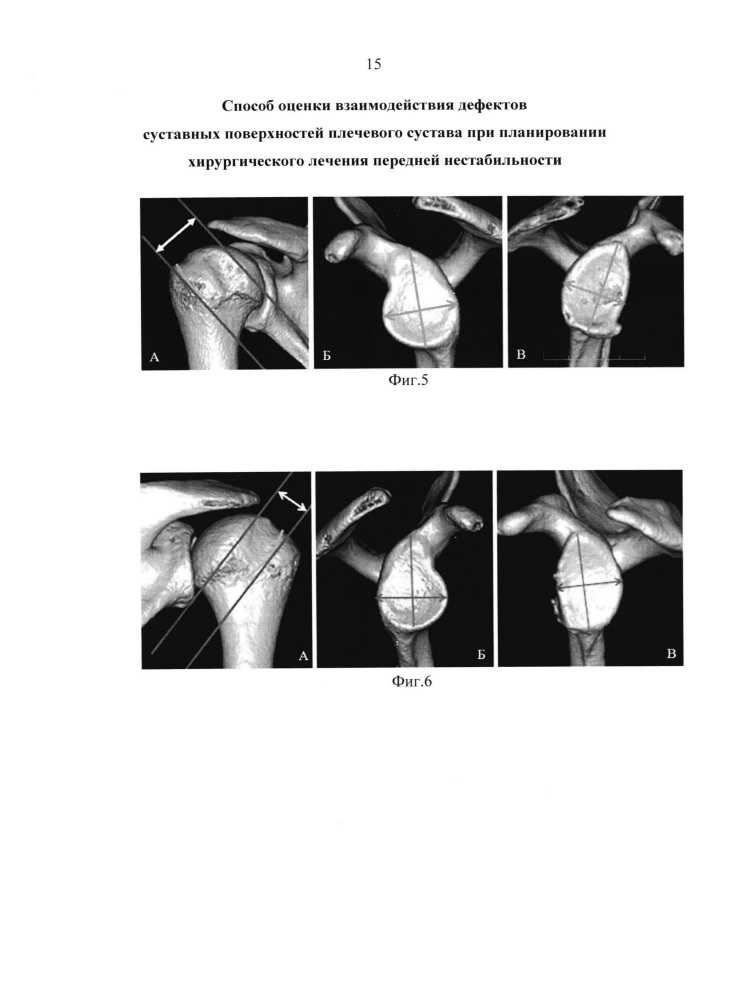 Способ оценки взаимодействия дефектов суставных поверхностей плечевого сустава при планировании хирургического лечения передней нестабильности (патент 2661717)