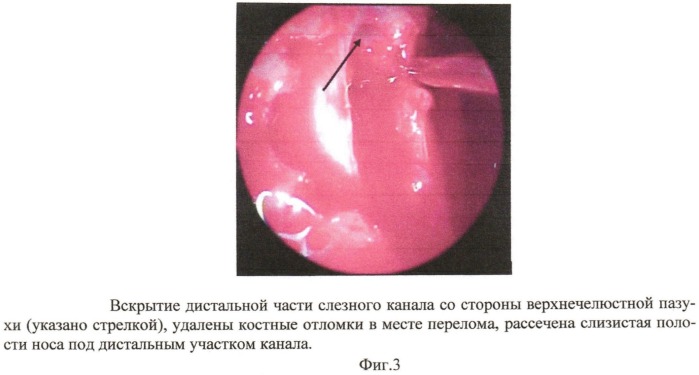 Способ хирургического лечения хронического дакриоцистита (патент 2532014)